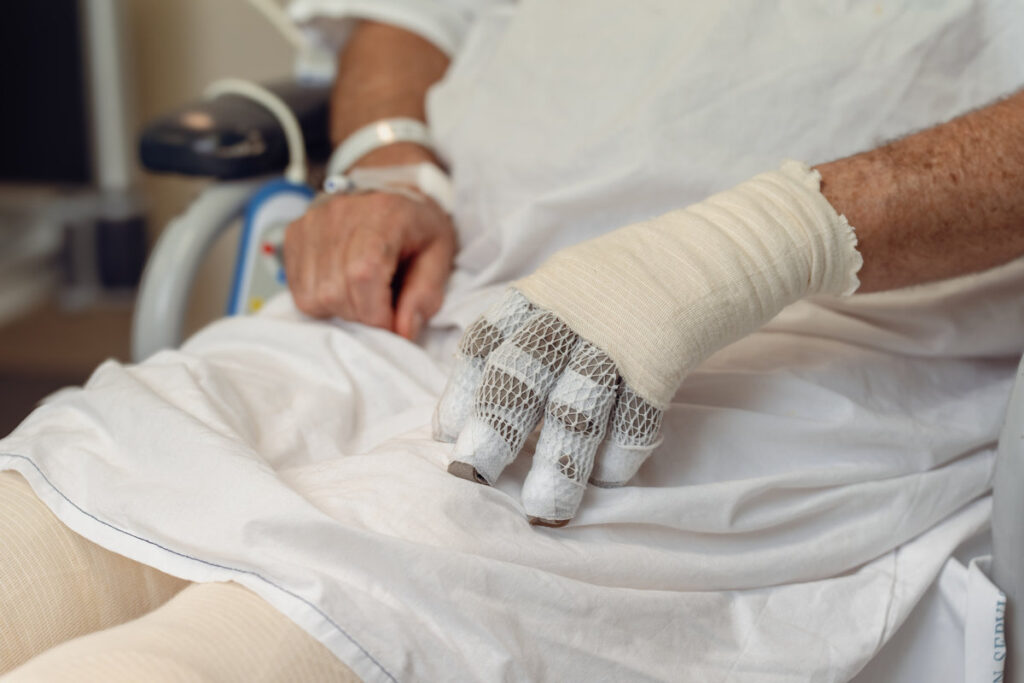 Burns Patient Recovery: Bandaged Hands in Hospital Care